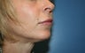 Lip Augmentation