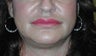lip augmentation