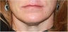 Lip augmentation - juvederm