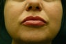 Restylane