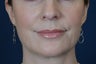 Lip Augmentation with Filler