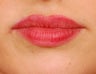 Lip Augmentation