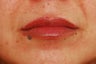 Lip Augmentation
