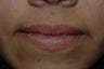 Lip Rejuvenation