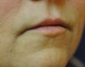 Lip Augmentation with Filler