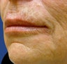 Lip Augmentation with Filler