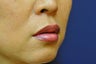 Lip Augmentation with Filler