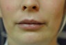 Lip Augmentation with Filler