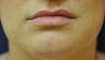 Lip Augmentation with Filler