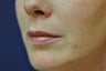 Lip Augmentation with Filler