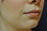Lip Augmentation with Filler