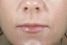 Lip Injection with hyaluronic acid.