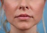 Lip Augmentation