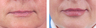 Lip Augmentation