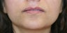 Lip Augmentation