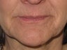 Lip Enhancement
