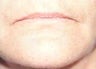 Lip Augmentation 