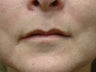 Lip Augmentation