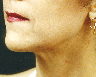 Lip Enhancement