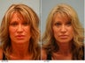 Lip Reduction for Correction of Silicone