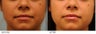 Lip Enhancement using Juvederm