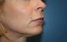 Lip Augmentation