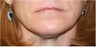 Lip augmentation - juvederm