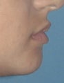 Lip Augmentation