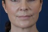 Lip Augmentation with Filler