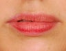 Lip Augmentation