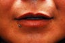 Lip Augmentation