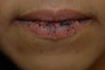 Lip Rejuvenation