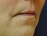 Lip Augmentation with Filler