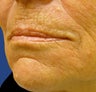 Lip Augmentation with Filler