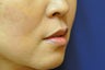 Lip Augmentation with Filler