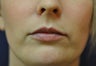 Lip Augmentation with Filler