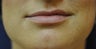 Lip Augmentation with Filler