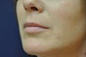 Lip Augmentation with Filler
