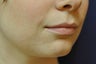 Lip Augmentation with Filler
