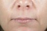 Lip Injection with hyaluronic acid.