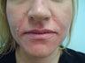 Lip Augmentation with Juvederm
