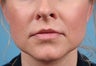 Lip Augmentation