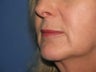 Lip Augmentation