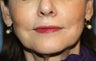 Lip Augmentation
