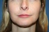 Lip Augmentation