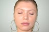 Lip Implant