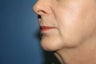 Lip Augmentation