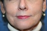 Lip Augmentation