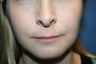 Lip Augmentation