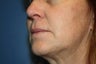 Lip augmentation